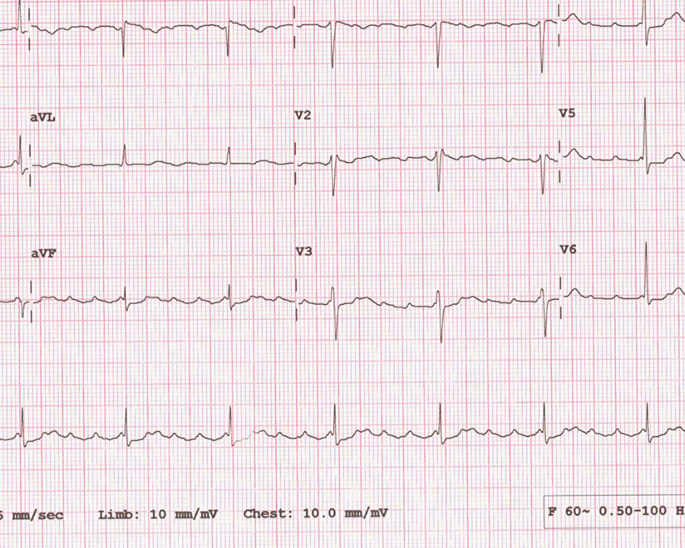 tips for after open heart surgery